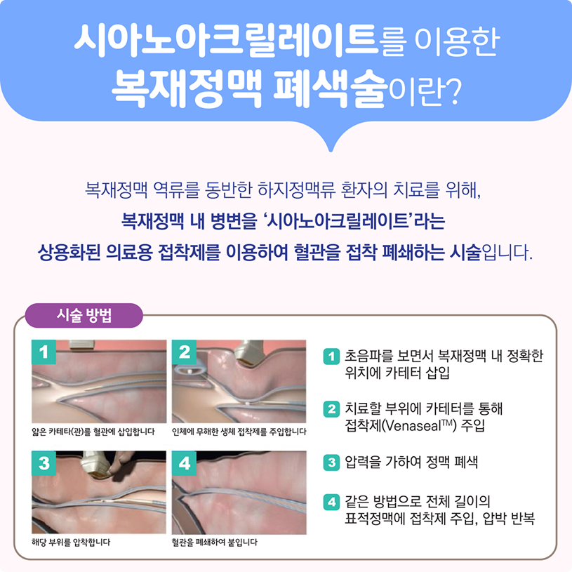 시아노아크릴레이트를 이용한 복재정맥 폐색술이란? 상세내용 하단참조