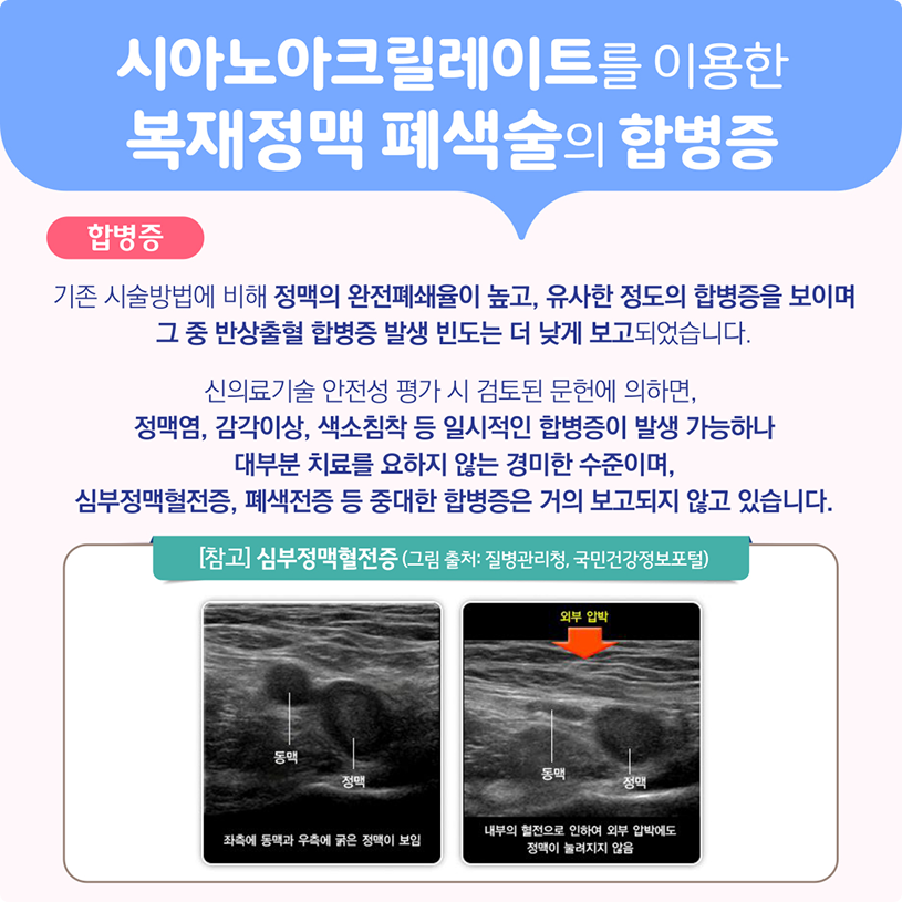시아노아크릴레이트를 이용한 복재정맥 폐색술의 합병증 상세내용 하단참조
