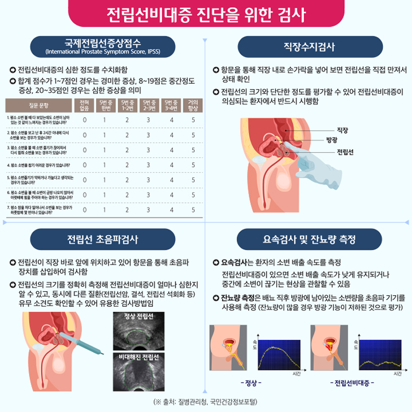 전립선비대증 진단을 위한 검사 상세내용 하단참조