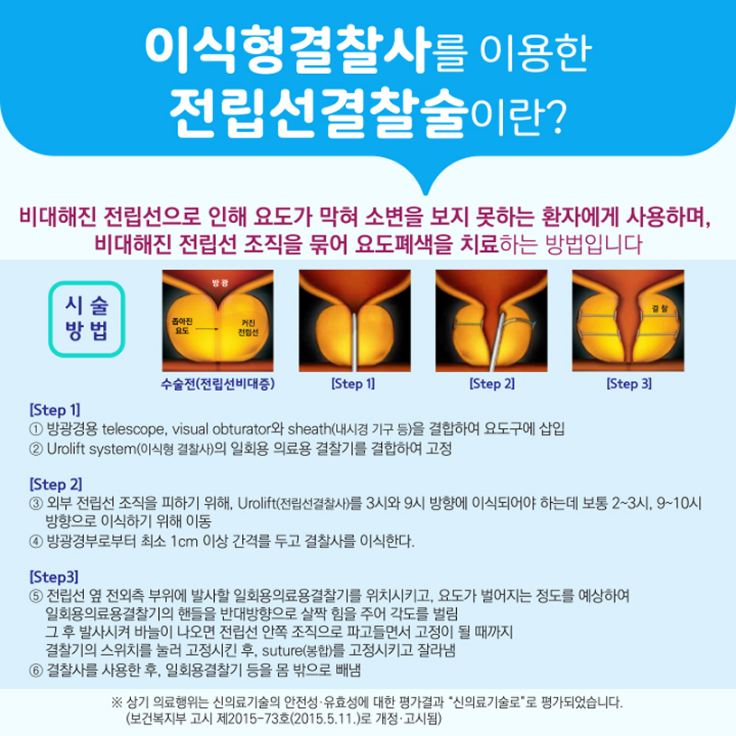 이식형결찰사를 이용한 전립선결찰술이란? 상세내용 하단참조