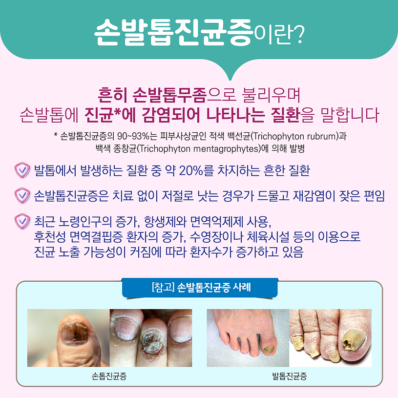 손발톱진균증이란? 상세내용 하단참조