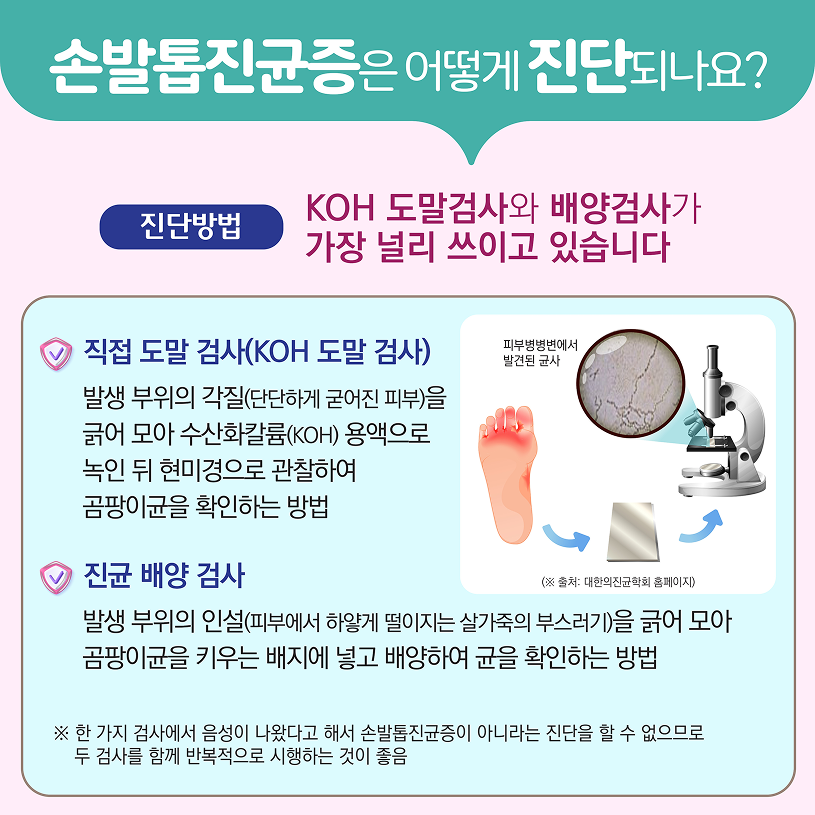 손발톱진균증은 어떻게 진단되나요? 상세내용 하단참조